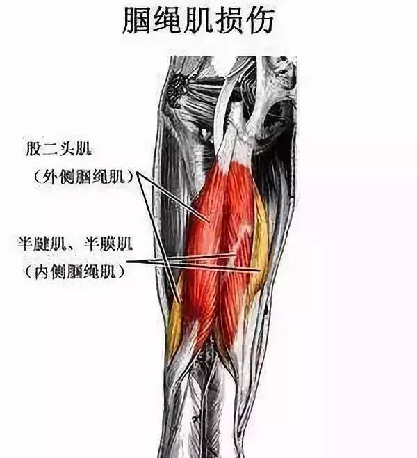 解剖      膎绳肌是大腿后侧的肌群,包括半腱肌,半膜肌,股二头肌长头
