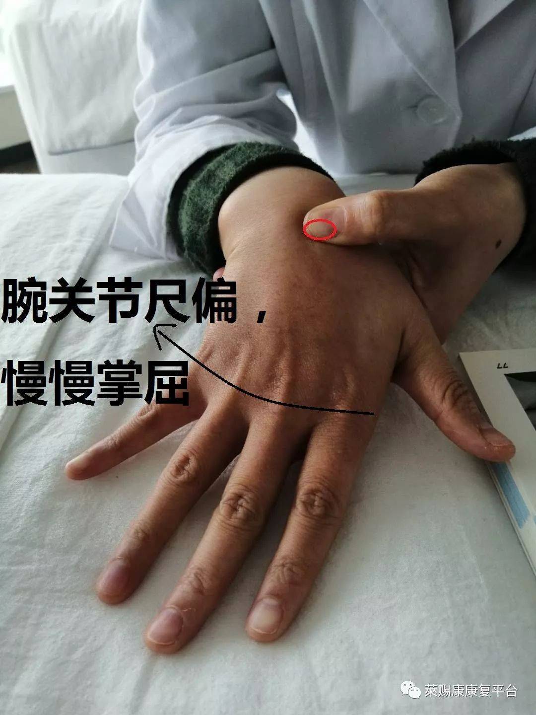 基础触诊教学:腕骨,指骨