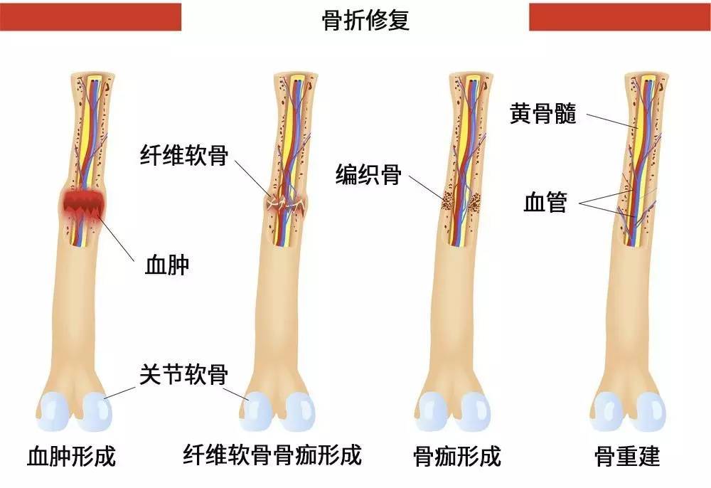 儿童骨折塑形能力图图片